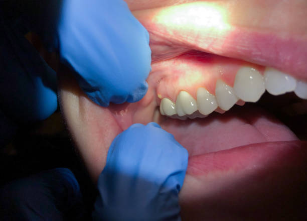 Best Emergency Dental Care for Broken or Chipped Teeth in Karnes City, TX