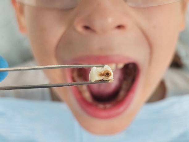 Best Emergency Dental Care for Broken or Chipped Teeth in Karnes City, TX